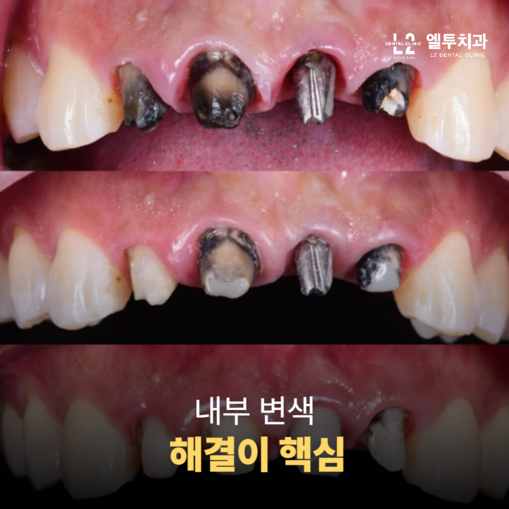 크라운 제거 후 드러난 변색된 치아 내부 상태