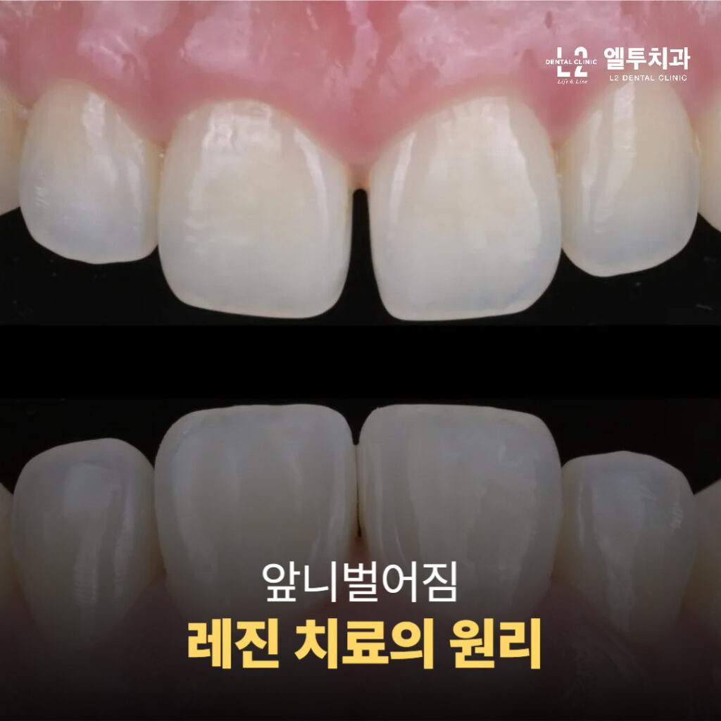 교정 없이 하루 만에 완성된 앞니벌어짐 레진 치료 전후 비교 사진