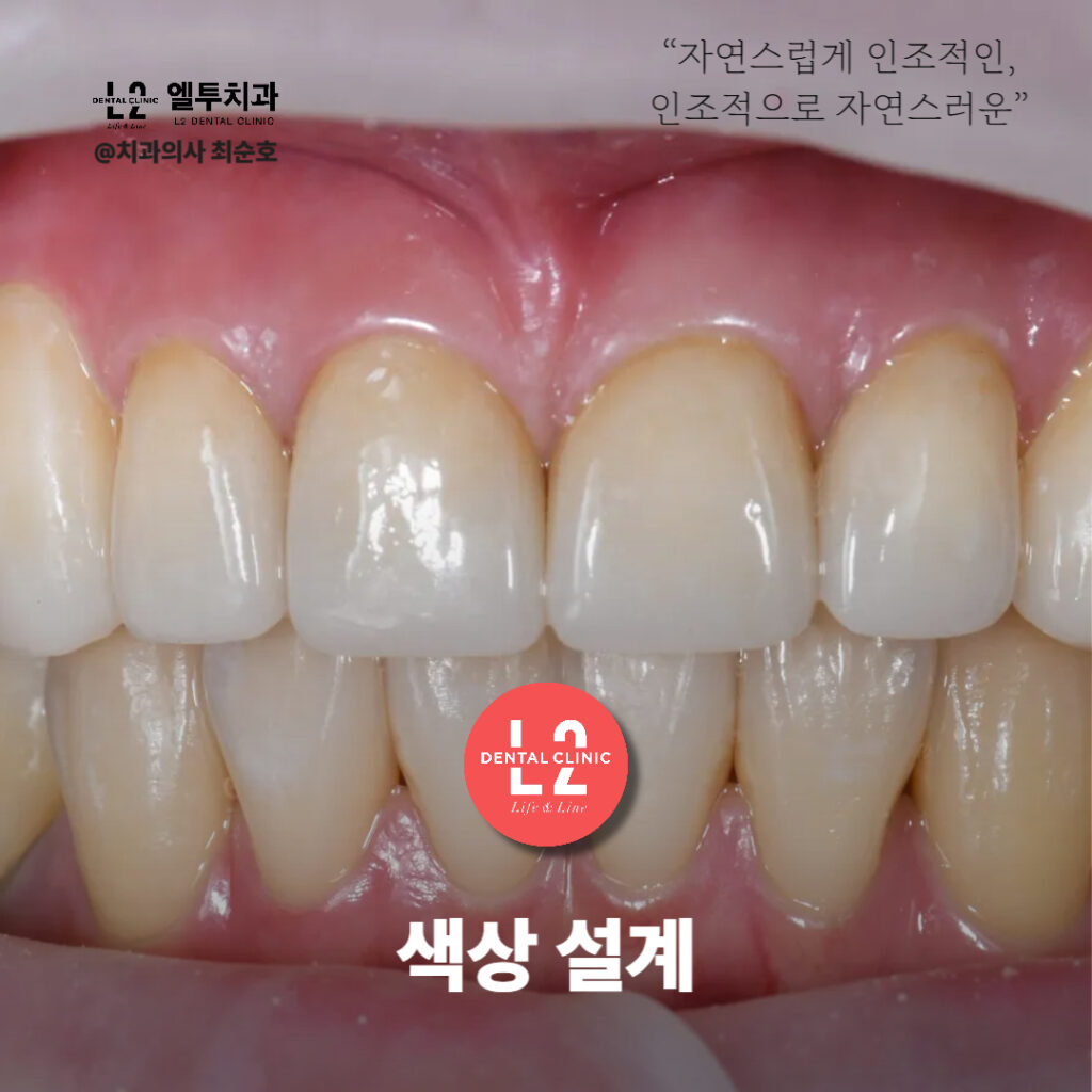 지르코니아 크라운으로 복원된 앞니의 색상 설계 결과