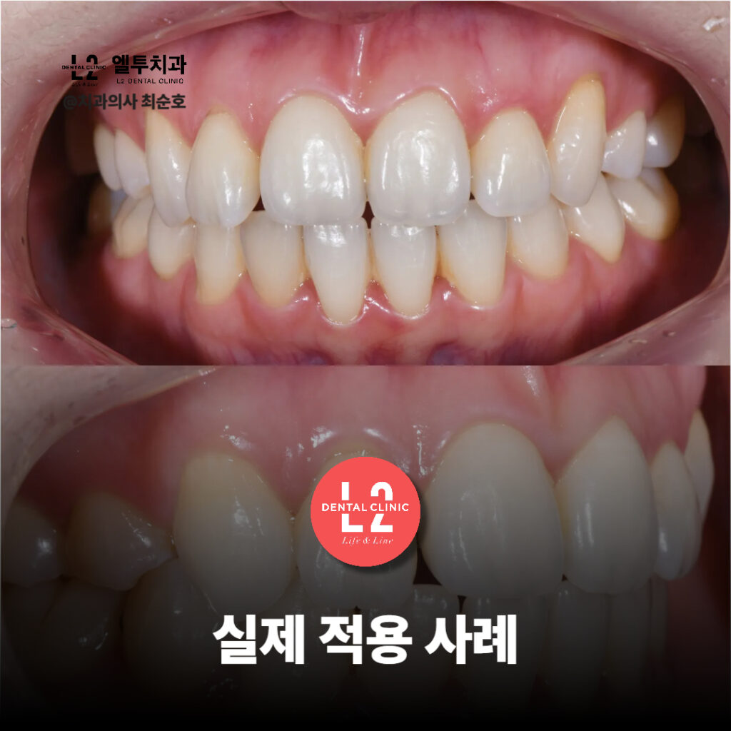 인비절라인 교정 전후의 실제 환자 사례를 비교한 치아 사진
