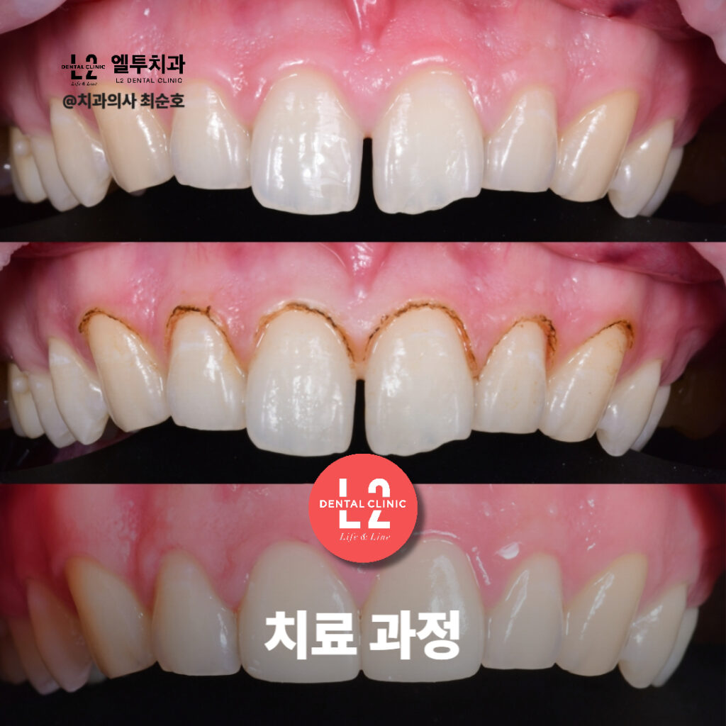 잇몸성형과 라미네이트 부착 과정을 거친 치료 단계별 변화