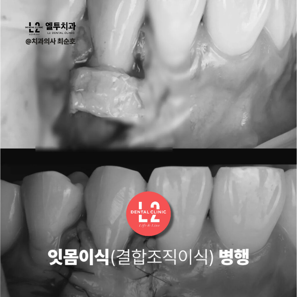 잇몸이식(결합조직이식) 수술 중과 수술 후 모습을 비교한 임상 이미지