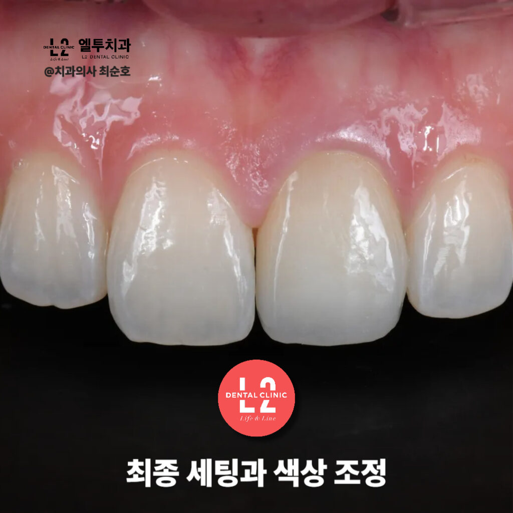 최종 세팅 후 색상 조정이 완료된 앞니 크라운