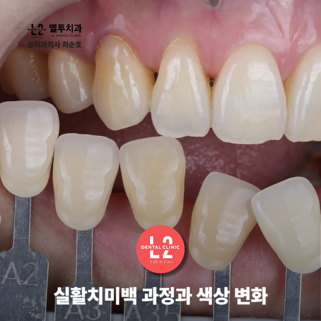 실활치미백 앞니변색 레진코어 치료 중 색상 측정 및 단계별 변화