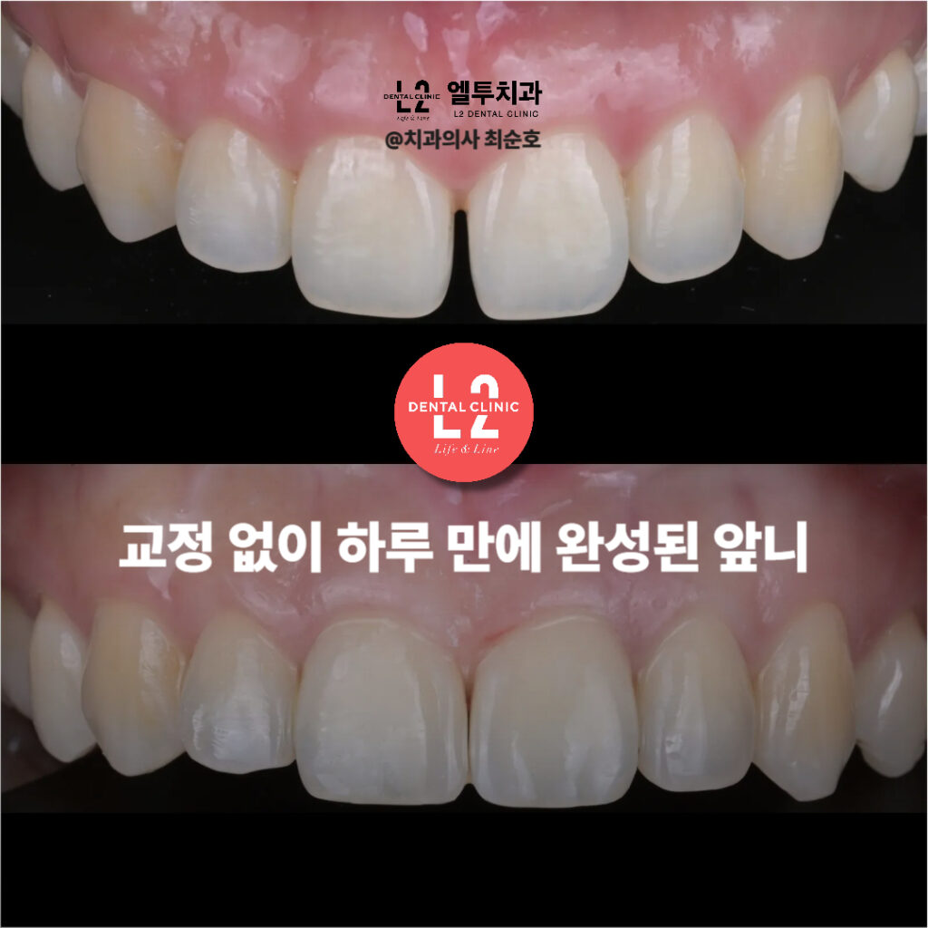 앞니벌어짐 레진 치료로 교정 없이 당일 심미 개선된 앞니 모습