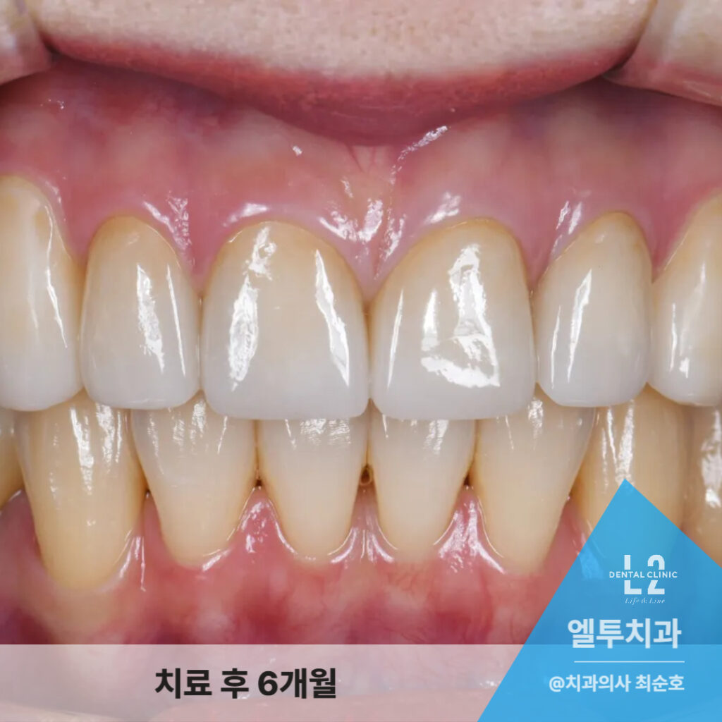 앞니 지르코니아 크라운 장착 6개월 후의 안정된 잇몸과 자연스러운 색감
