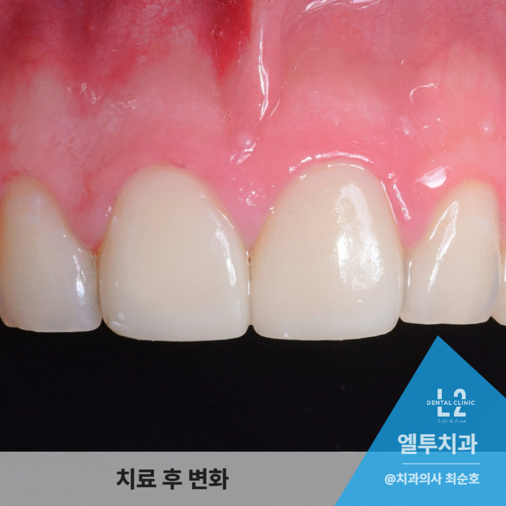 라미네이트 부착 6개월 후의 앞니 상태, 자연스럽게 닫힌 간격