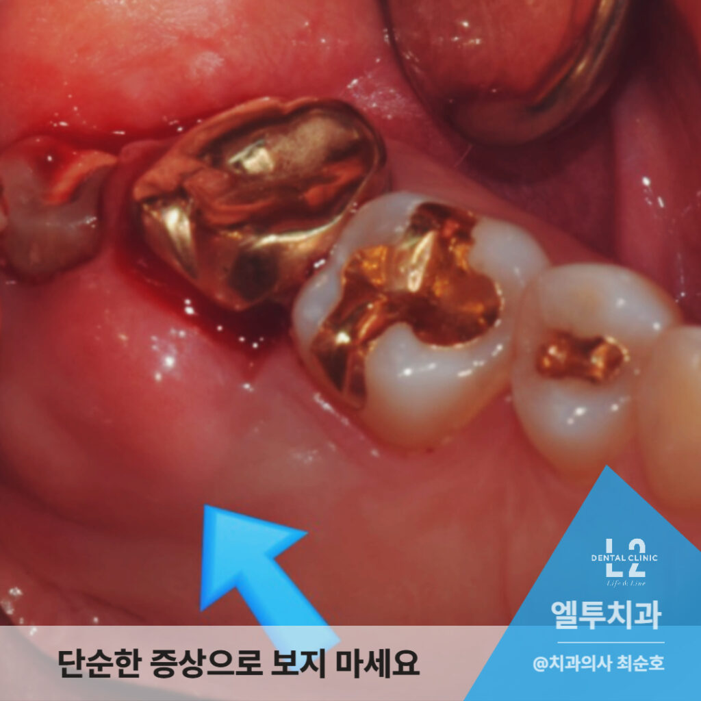 잇몸에 붉게 부풀어 오른 고름주머니와 염증 부위를 가리키는 화살표 이미지