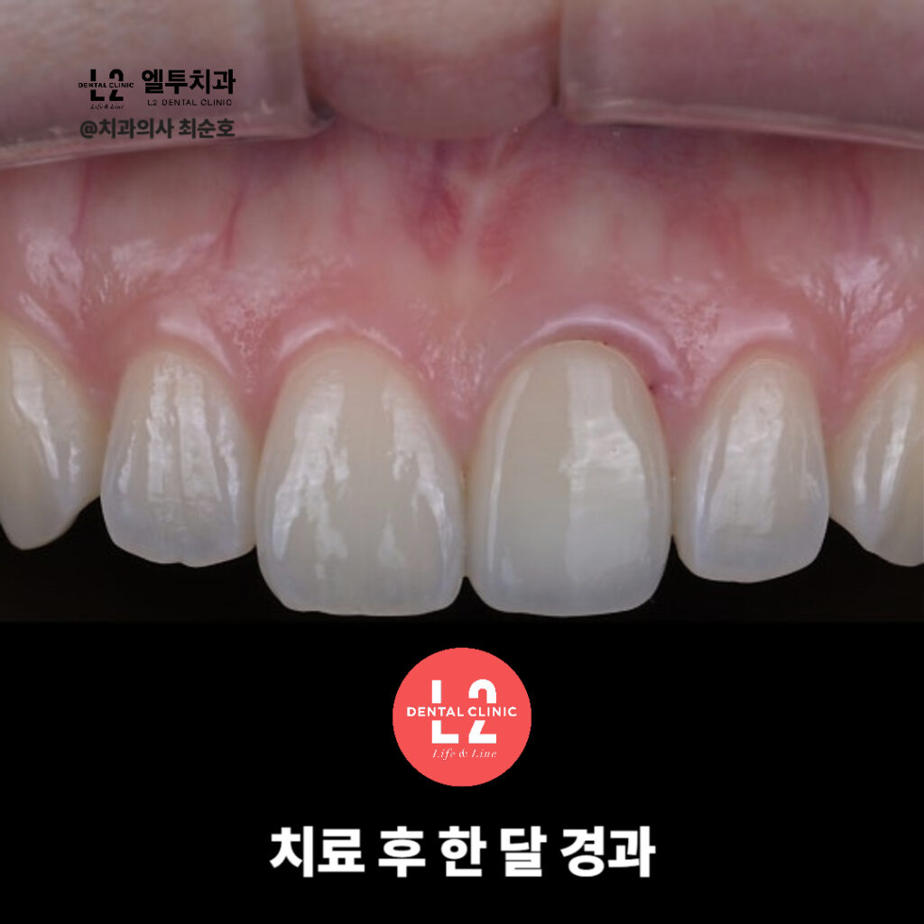 앞니 크라운교체 치료 후 한 달이 지난 경과 모습