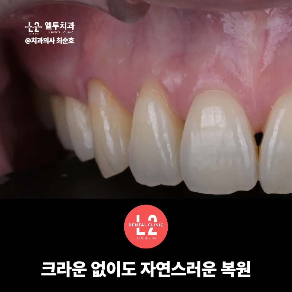 실활치미백 앞니변색 레진코어 치료 후 크라운 없이 복원된 앞니 모습