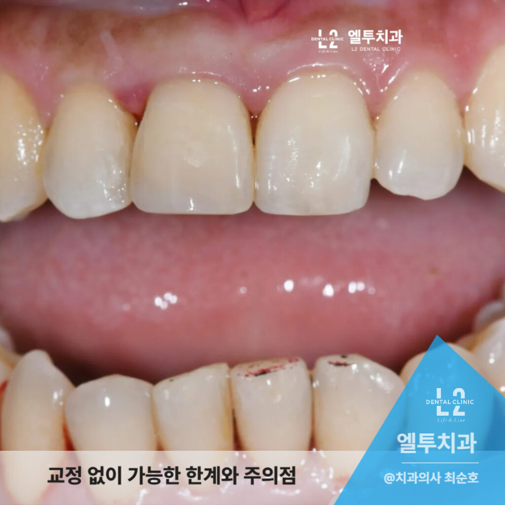 교정 없이 가능한 앞니벌어짐 레진 치료의 한계와 주의점