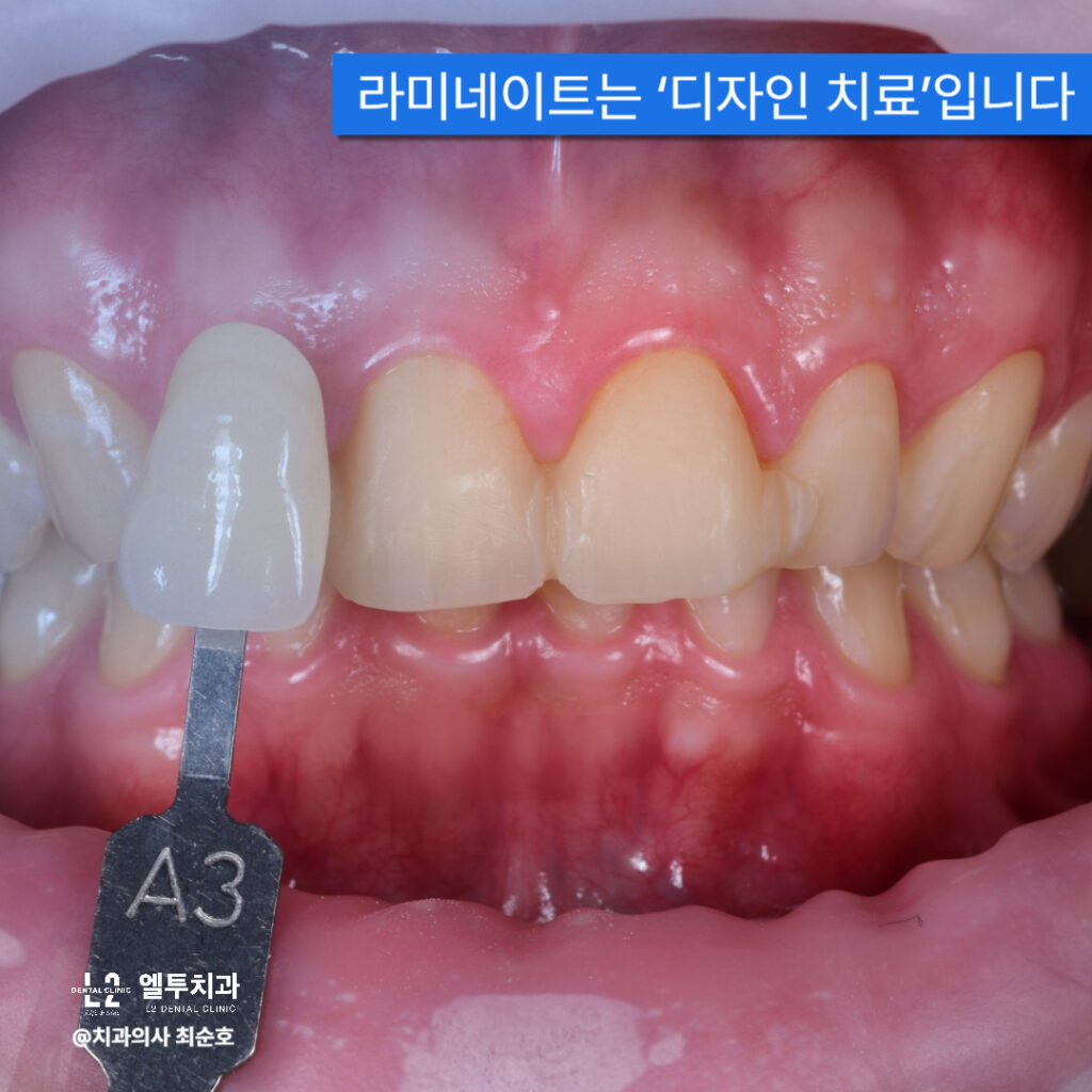 라미네이트 색상 비교와 투명도 조정 과정에서의 세라믹 시적 장면