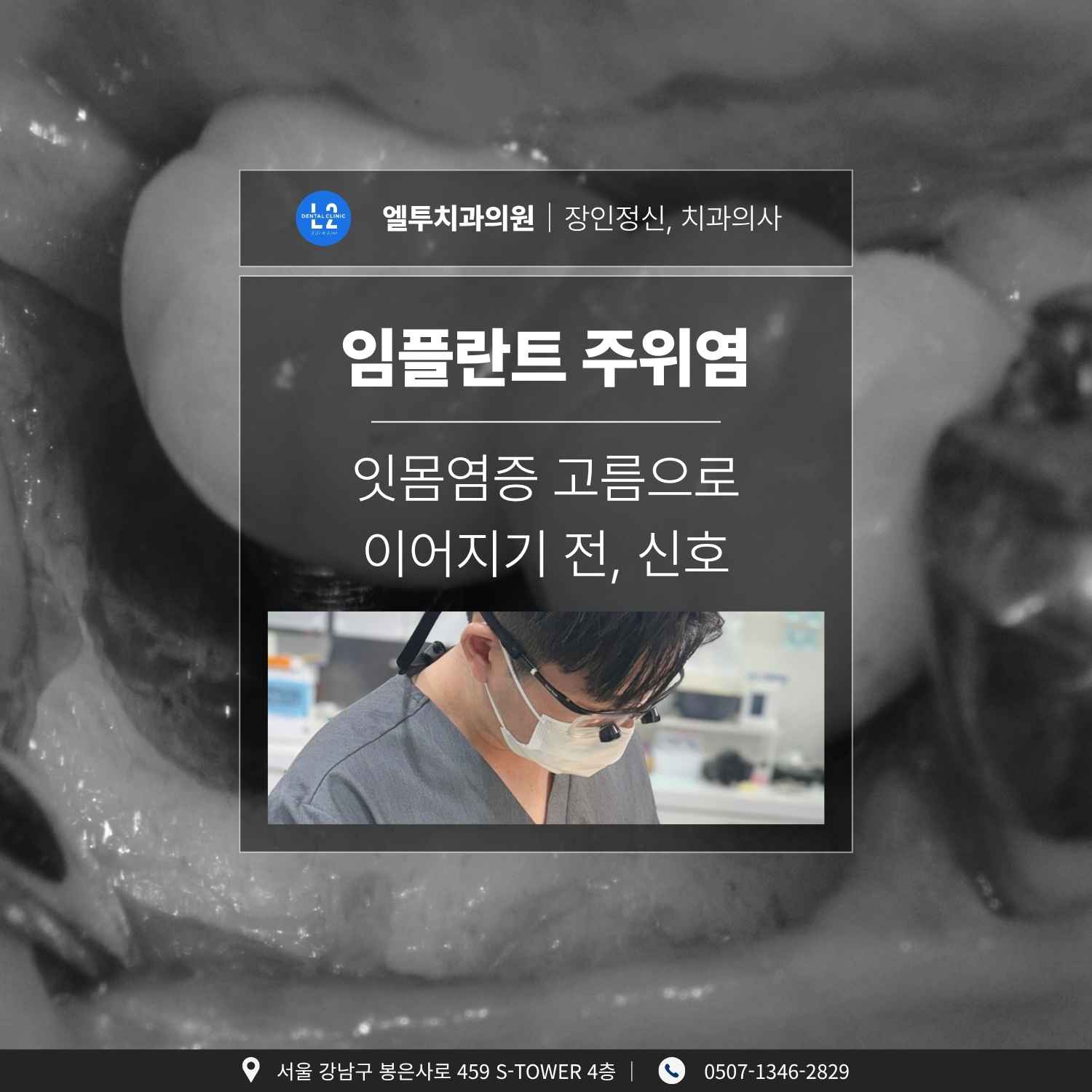 플란트 주위염 초기 증상과 잇몸염증 고름 전 단계 진단