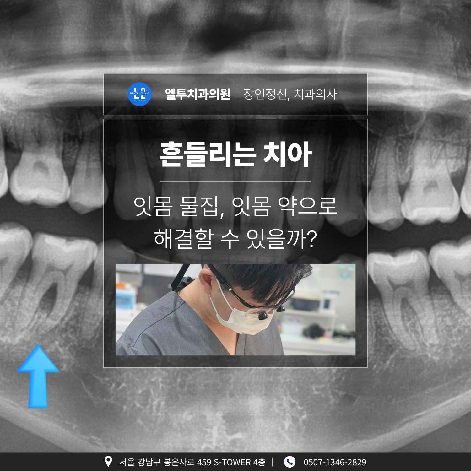 흔들리는 치아와 잇몸 물집, 잇몸 약으로 치료가 가능한가를 설명하는 엘투치과의원 대표 이미지