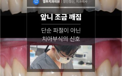 앞니 조금 깨짐 단순 파절이 아닌 치아부식의 신호일 수 있습니다