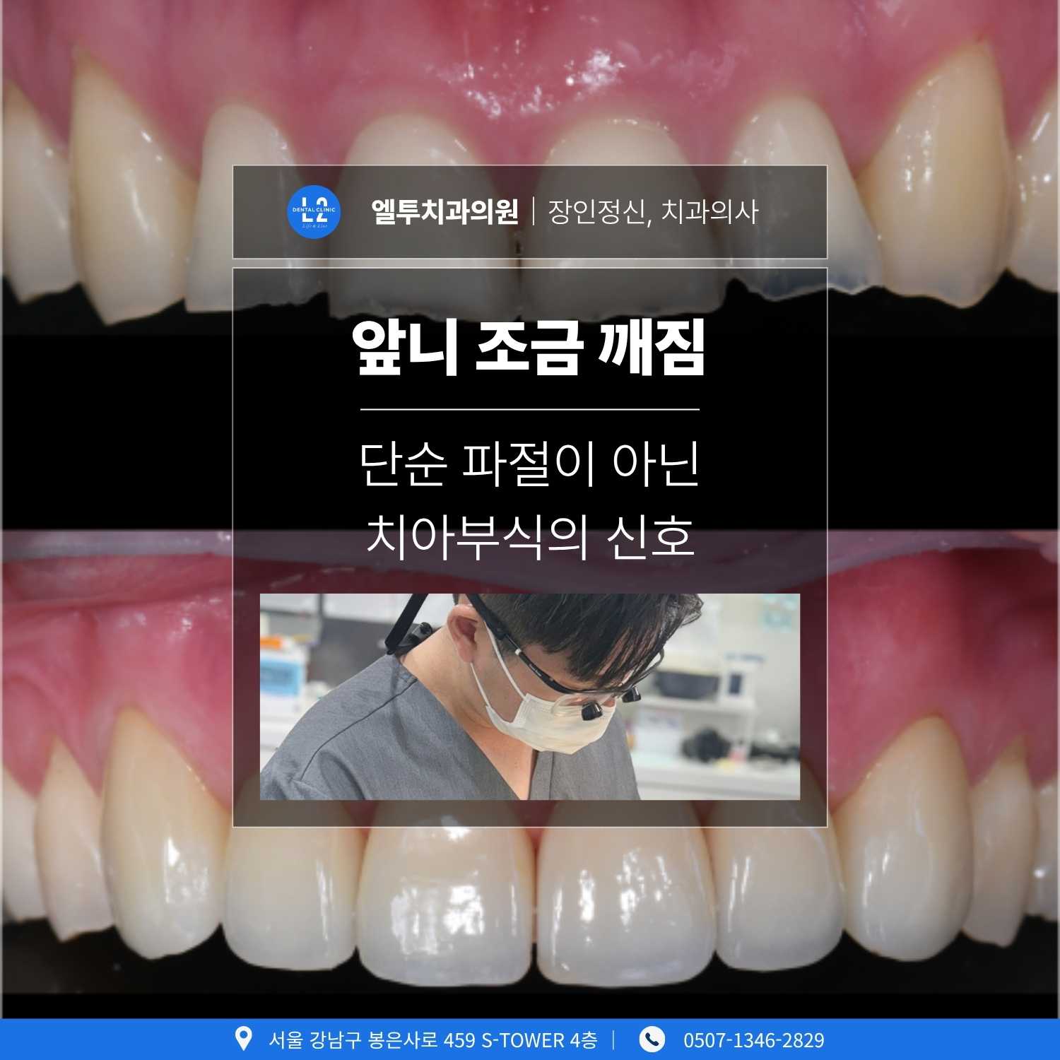 앞니 조금 깨짐 증상과 치아부식으로 인한 파절 치료 사례