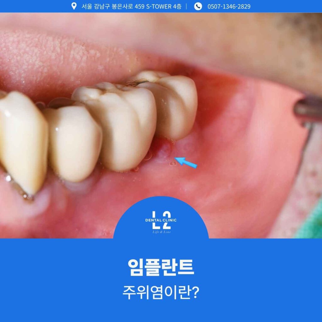 임플란트 주위염으로 인한 잇몸 부위 염증과 고름 사진