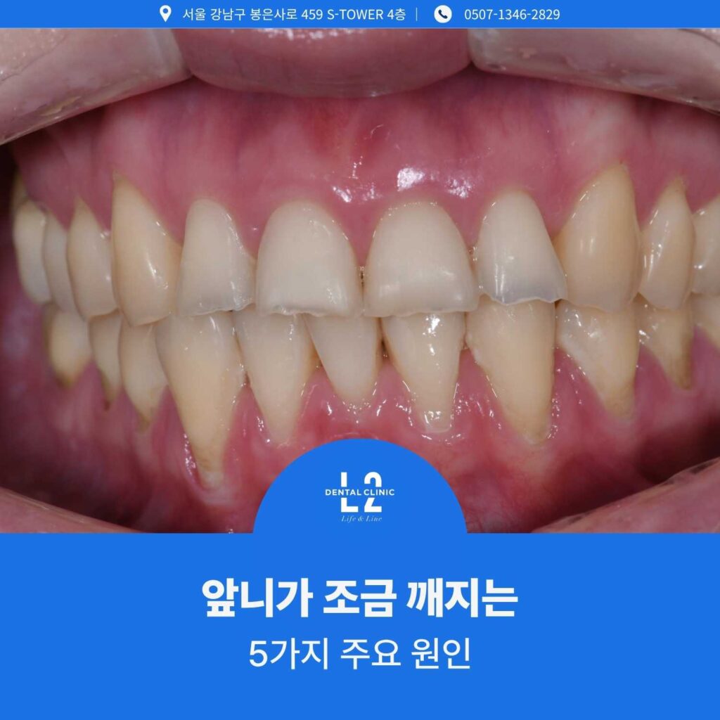 앞니가 조금 깨지는 5가지 주요 원인 설명 이미지