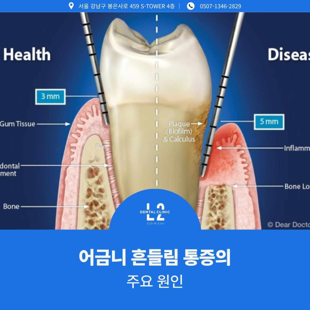 어금니 흔들림 통증의 원인, 잇몸뼈 손실 단계 비교 이미지