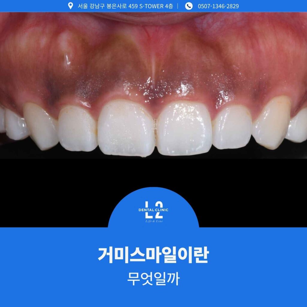 거미스마일 환자의 잇몸 상태 사진