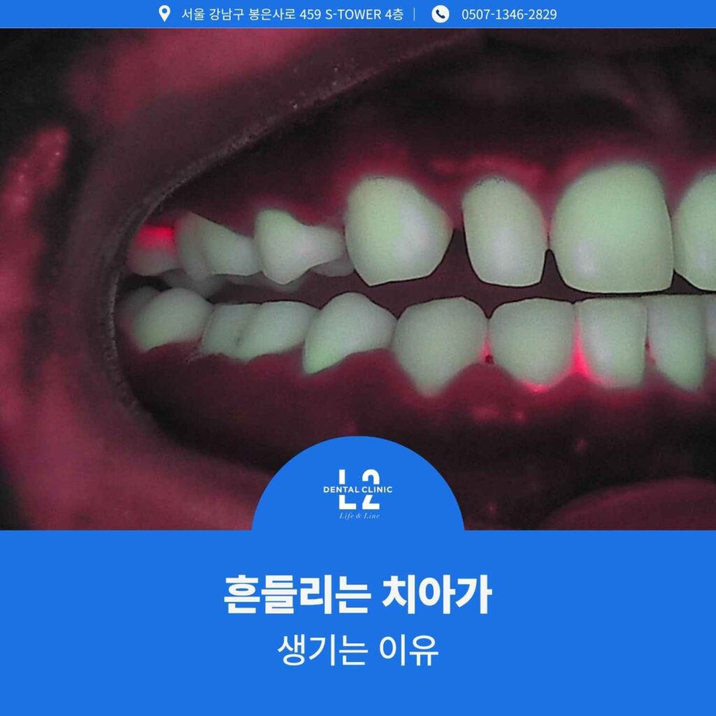 잇몸이 붓고 흔들리는 치아를 보여주는 구강 내 임상 이미지