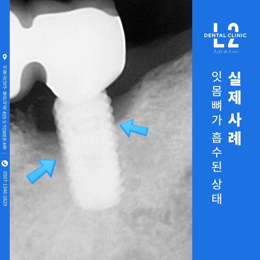 임플란트 주위염으로 인한 잇몸뼈 흡수 상태를 보여주는 엑스레이