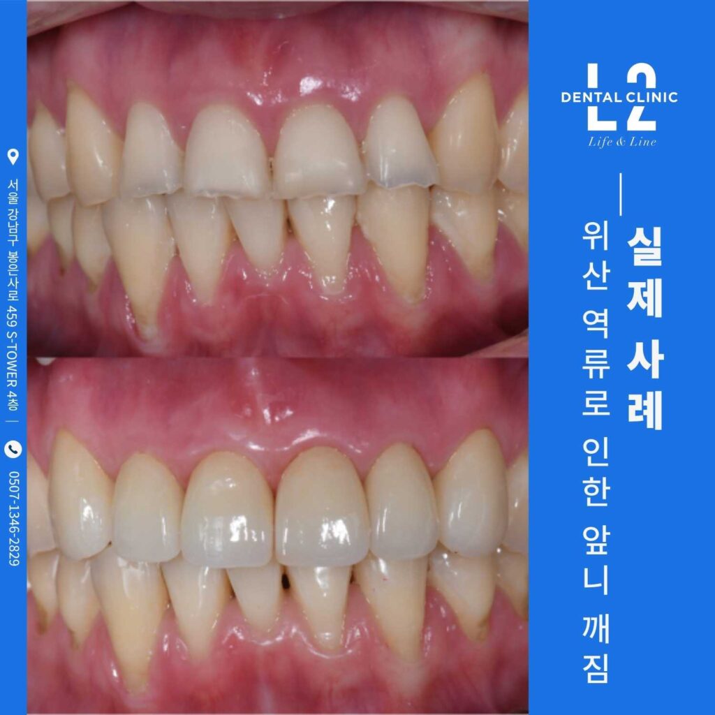 위산 역류로 인한 앞니 조금 깨짐 실제 사례 전후 비교