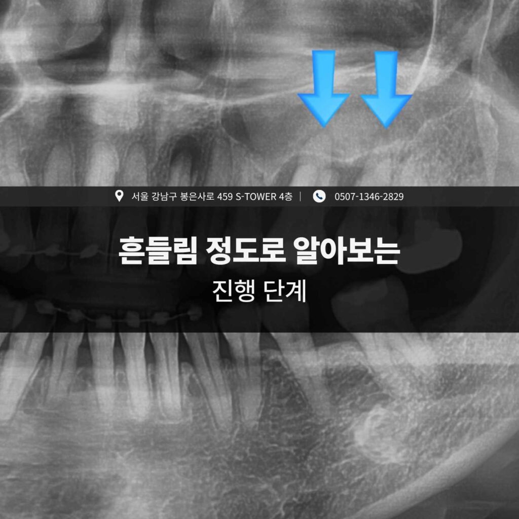 치아 엑스레이로 본 어금니 흔들림 진행 단계