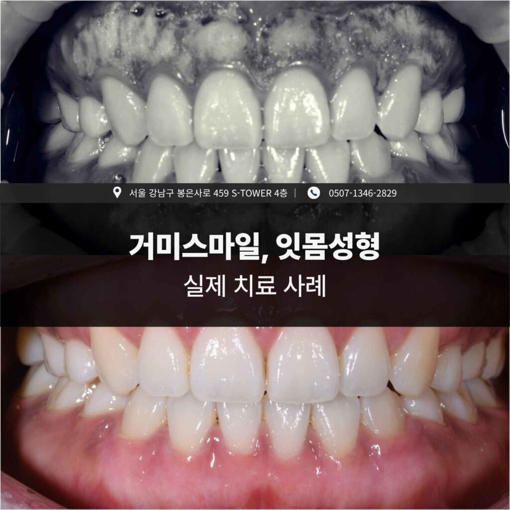 거미스마일 환자의 잇몸성형 실제 치료 사례