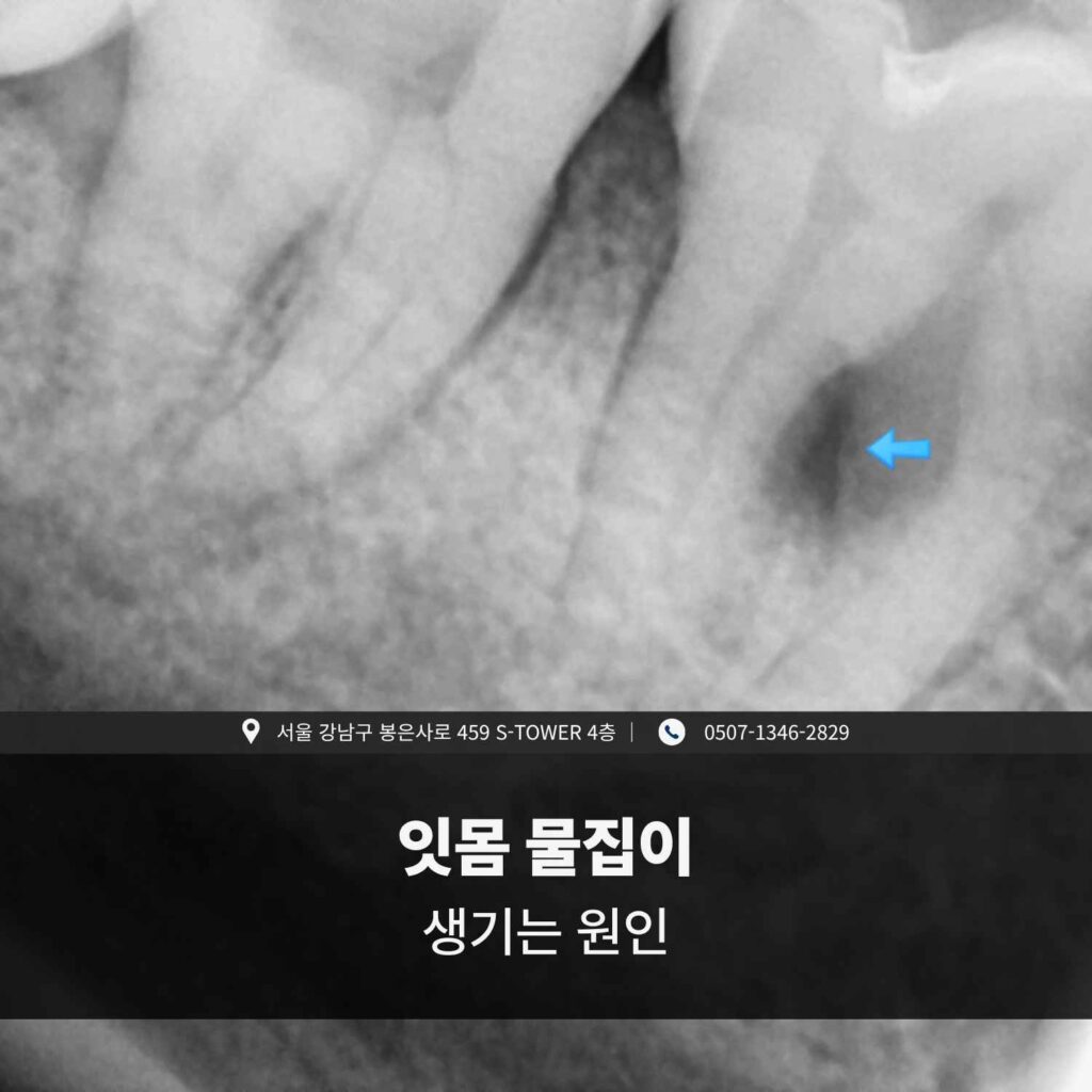 잇몸 속 염증으로 고름이 차며 물집이 생긴 부위를 보여주는 치근 엑스레이 사진
