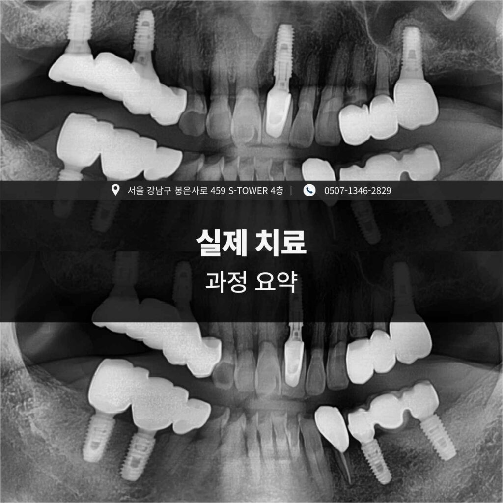 임플란트 주위염 치료 과정 요약 엑스레이 이미지