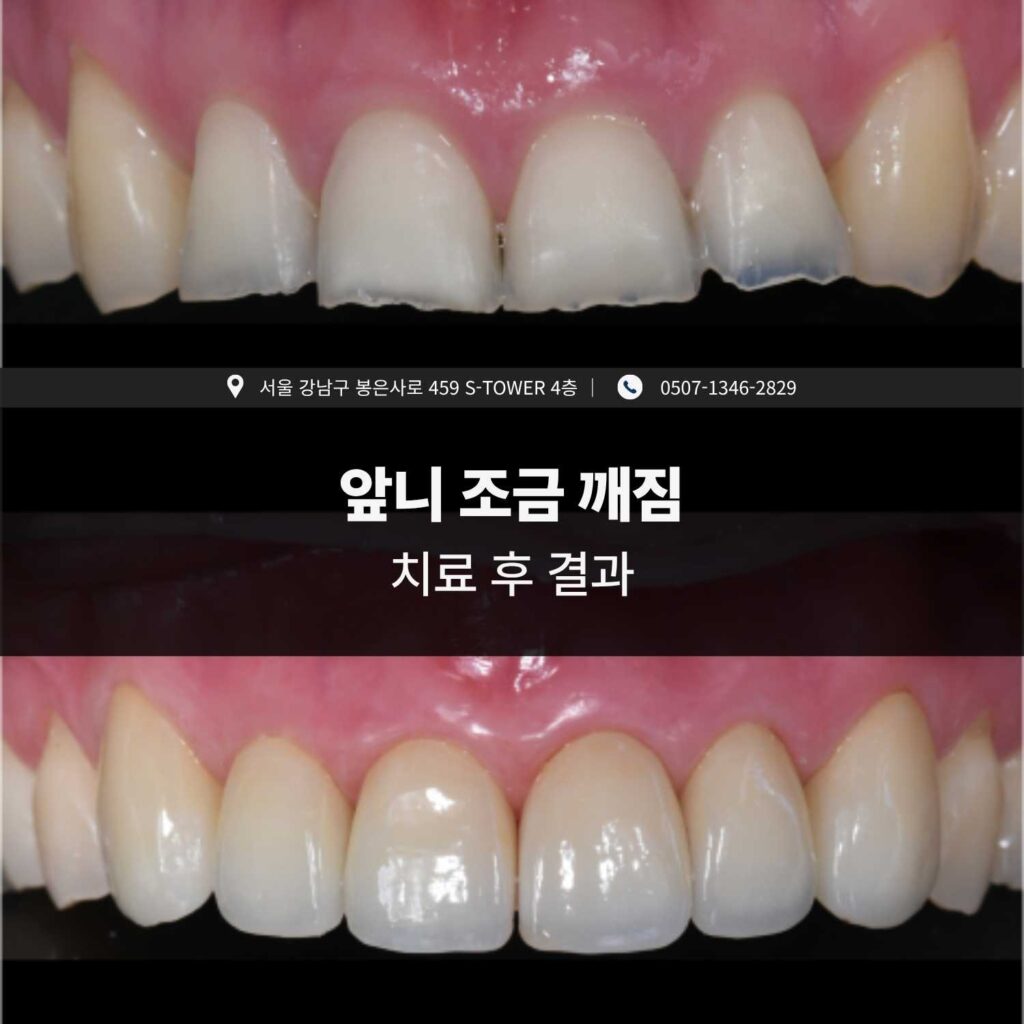 앞니 조금 깨짐 치료 전후 비교 결과
