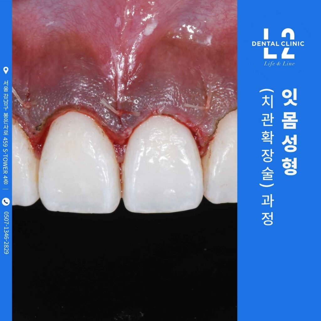 거미스마일 교정을 위한 잇몸성형 치관확장술 과정