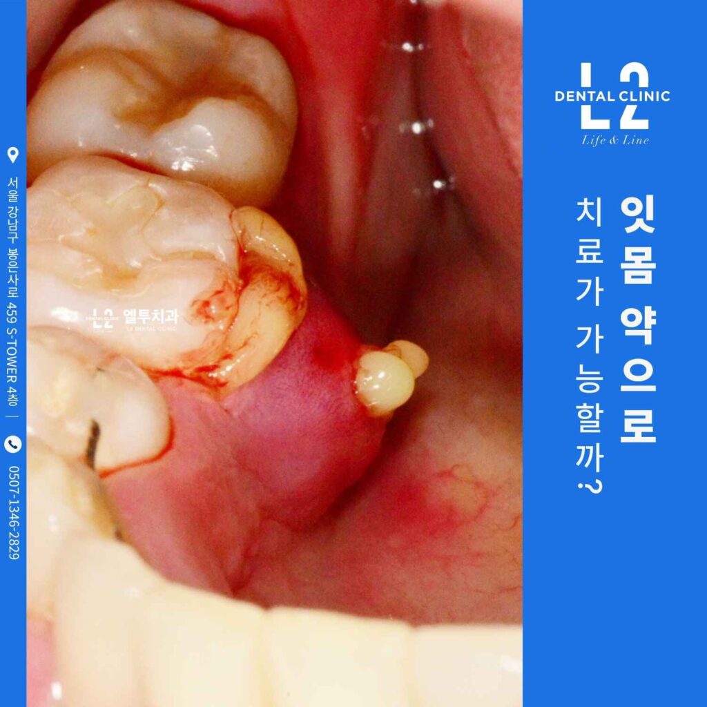 잇몸에 고름이 차고 항생제 잇몸 약으로 치료 중인 구강 내부 사진