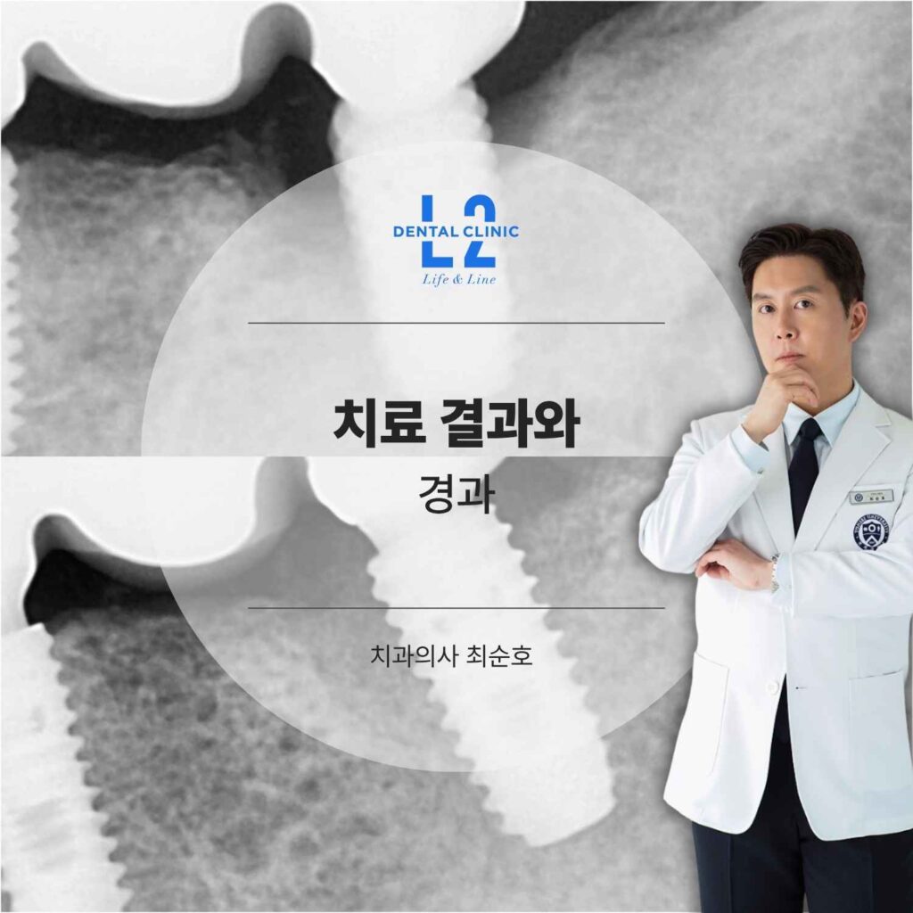 임플란트 주위염 치료 결과와 엘투치과 최순호 원장