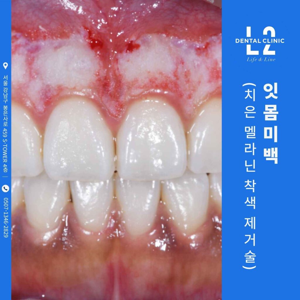 레이저를 이용한 잇몸미백 치은 멜라닌 착색 제거술