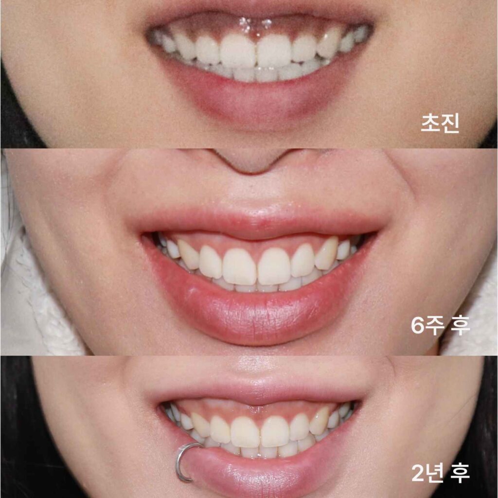 거미스마일 환자의 잇몸성형 및 잇몸미백 시술 전후 비교