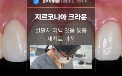 앞니 지르코니아 크라운 실활치 미백 잇몸 통증 재치료 과정