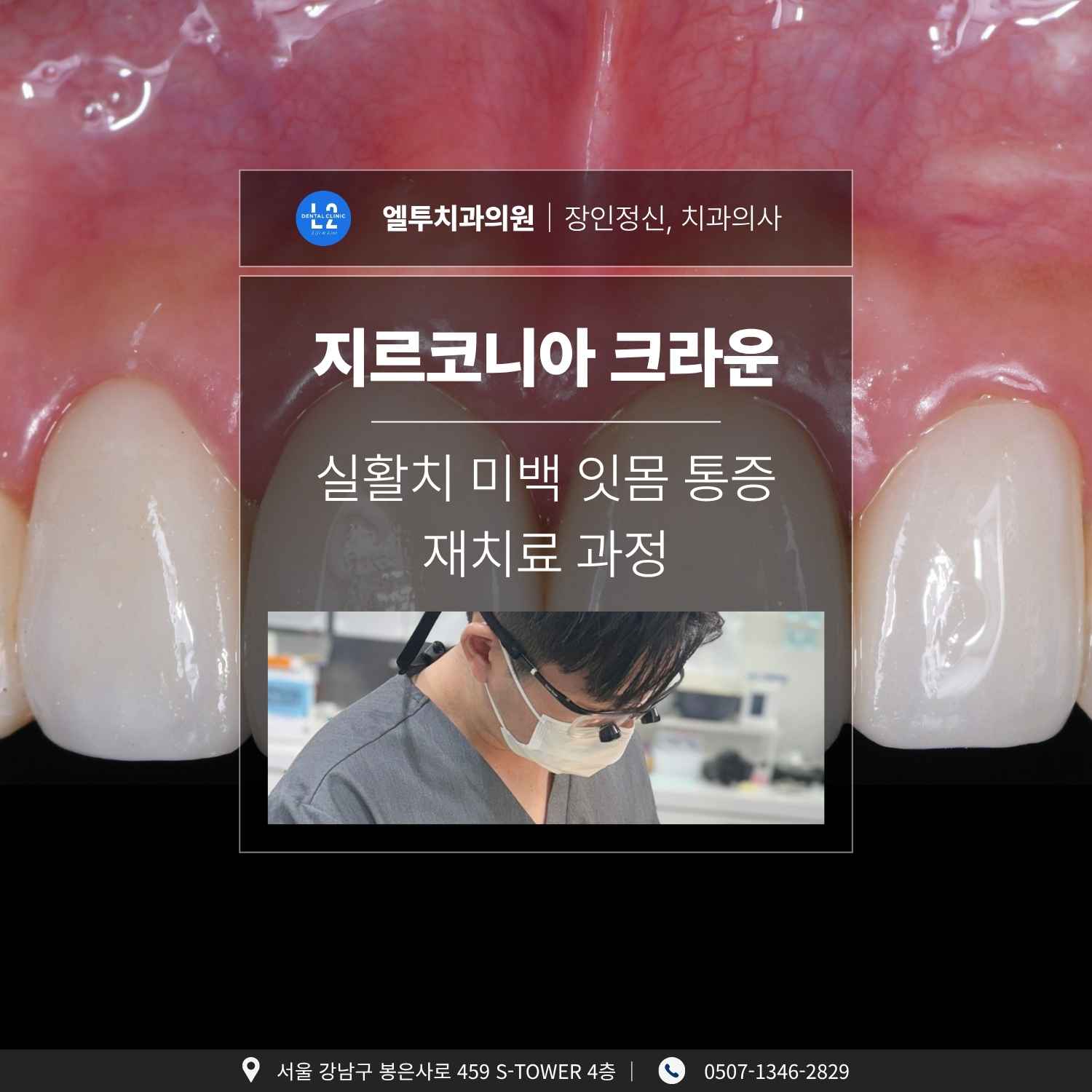 지르코니아 크라운 재치료 메인 이미지 앞니 지르코니아 크라운과 잇몸이 보이는 클로즈업 이미지와 치과 시술 준비 중인 의료진 모습