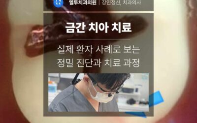 금간 치아 치료, 실제 환자 사례로 보는 정밀 진단과 치료 과정