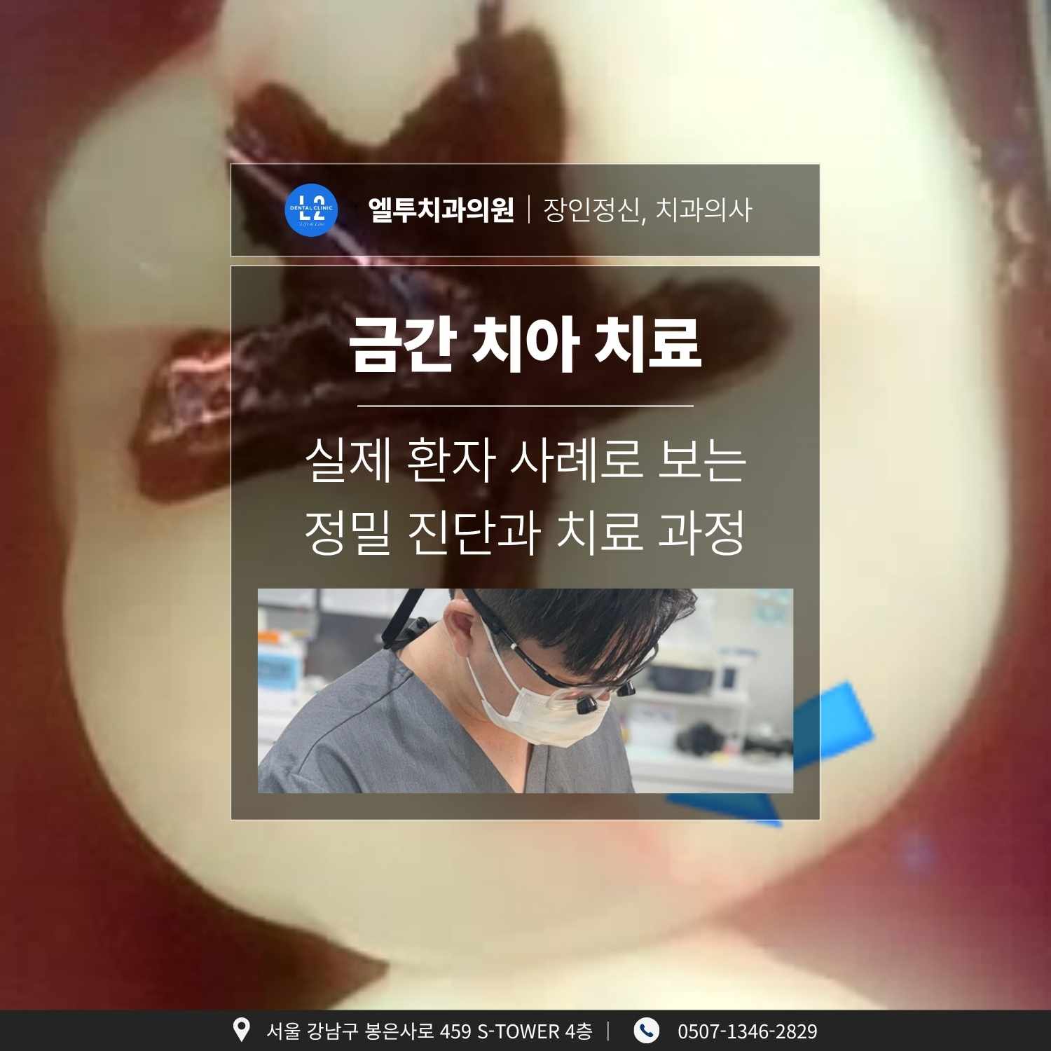 금간 치아 치료 – 실제 환자 사례 중심 진단 및 치료 금간 치아 치료 실제 환자 사례로 본 정밀 진단과 치료 과정