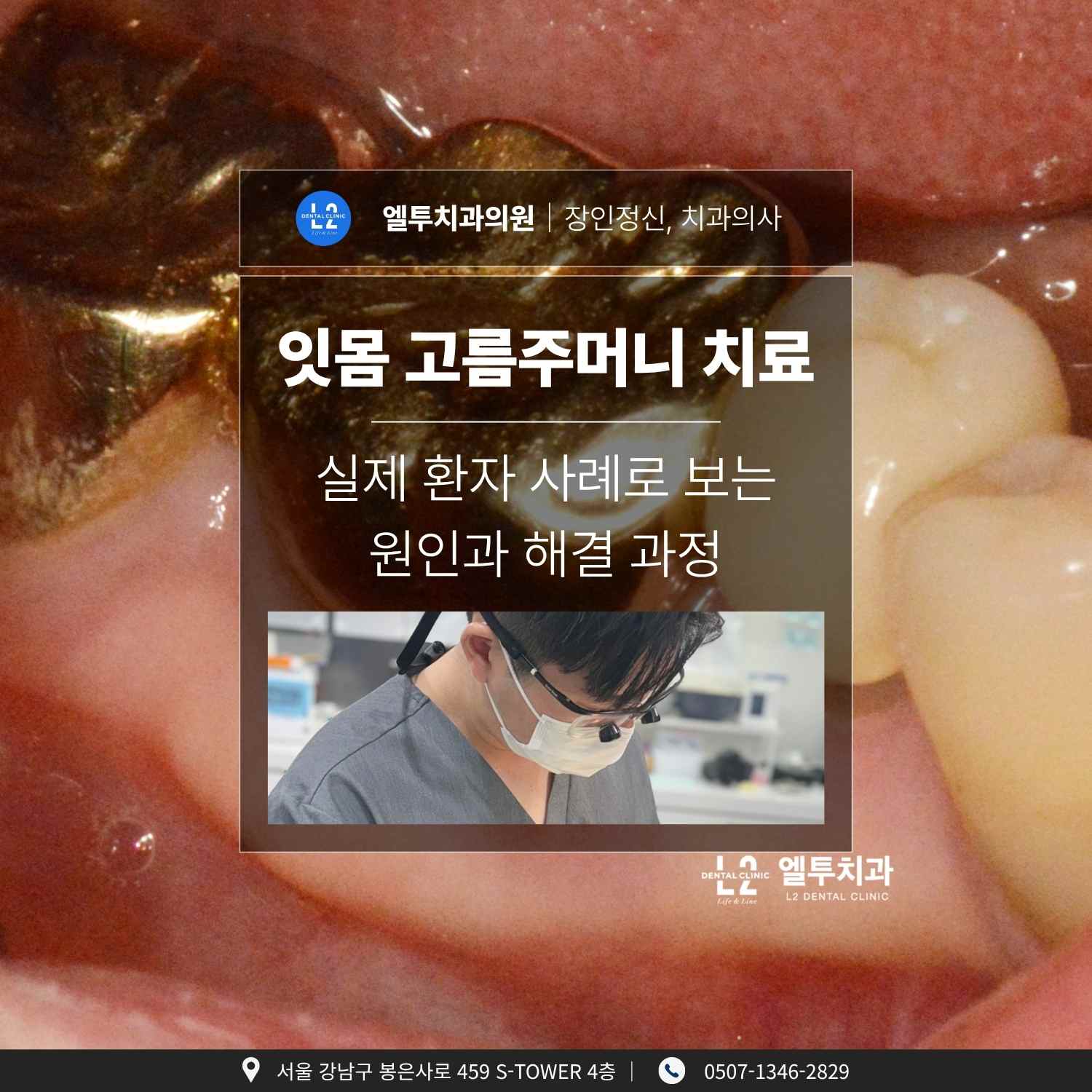 잇몸 고름주머니 치료 실제 환자 사례로 본 원인과 해결 과정