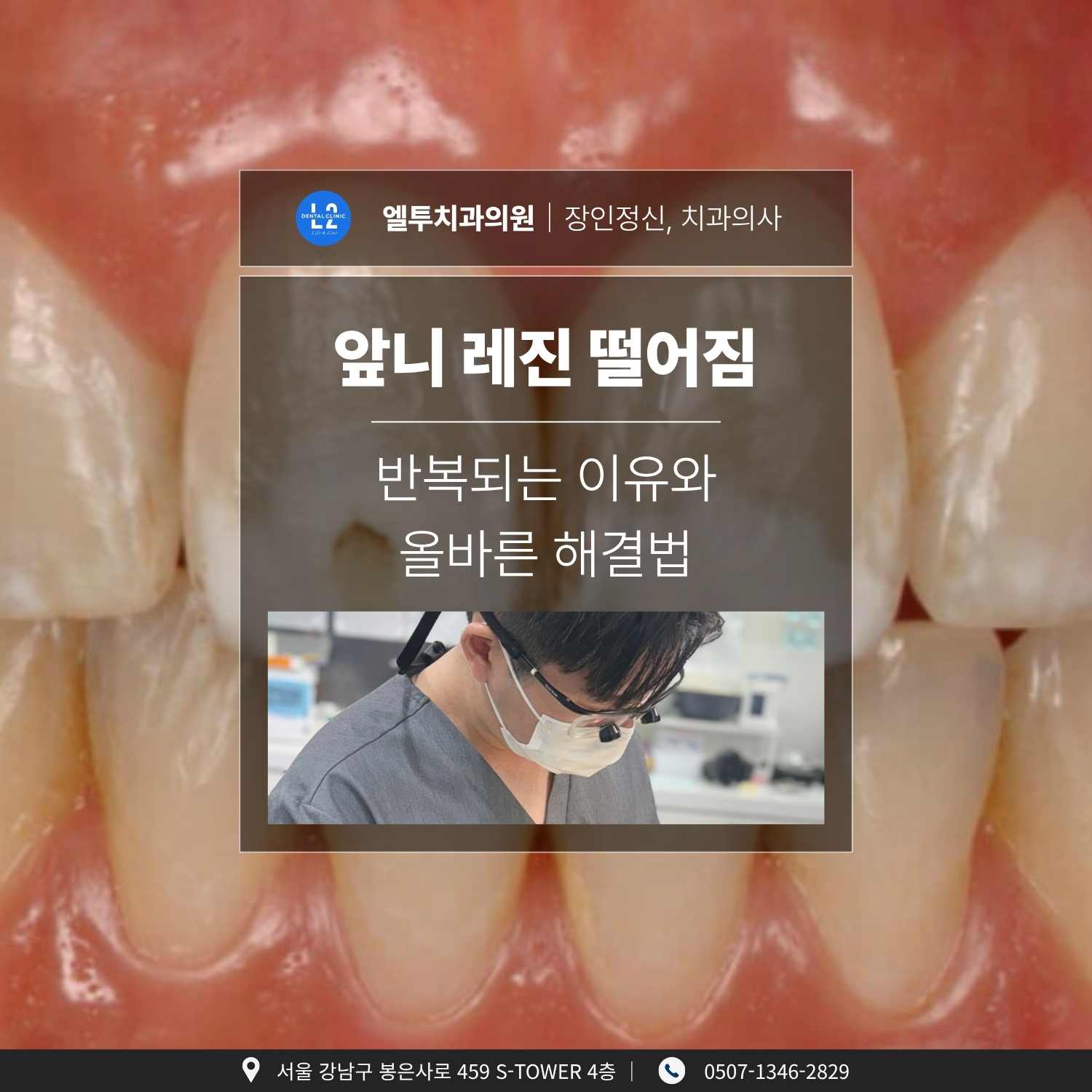 앞니 레진 떨어짐 치료 과정 앞니 레진 떨어짐 치료 과정과 치과의사가 시술 준비 중인 모습