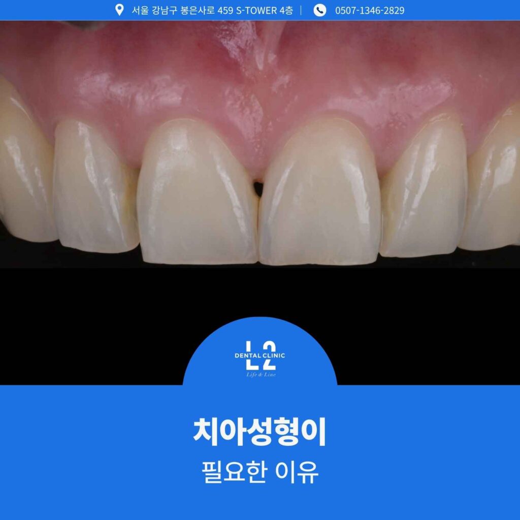 마모와 비대칭이 있는 앞니를 확대해 보여주는 사진