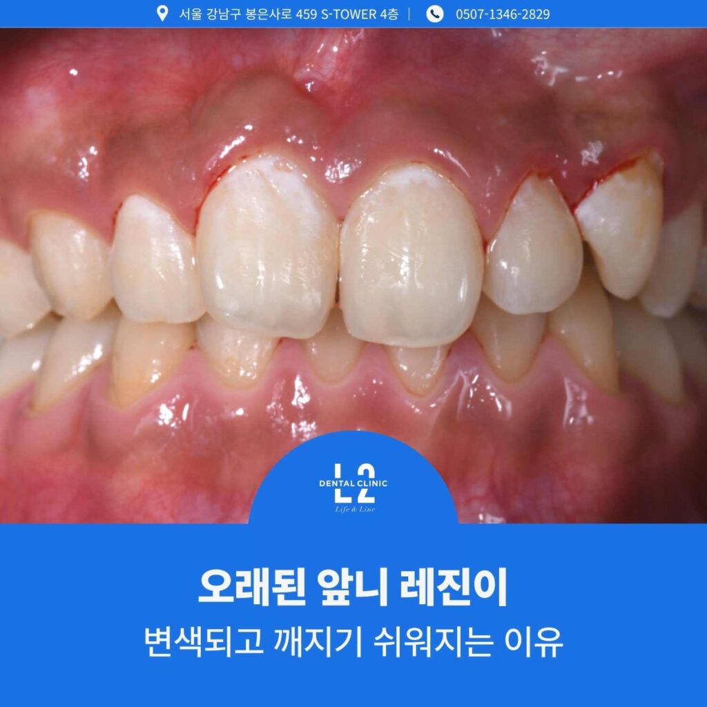오래된 앞니 레진이 변색되고 경계부 변형이 나타난 치아 사진