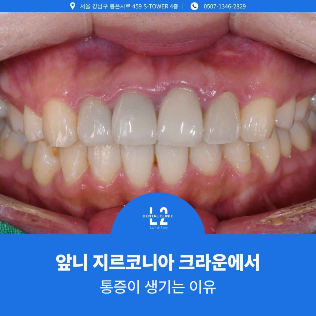 앞니 지르코니아 크라운이 장착된 상태에서 잇몸과 치열 전체가 보이는 임상 사진
