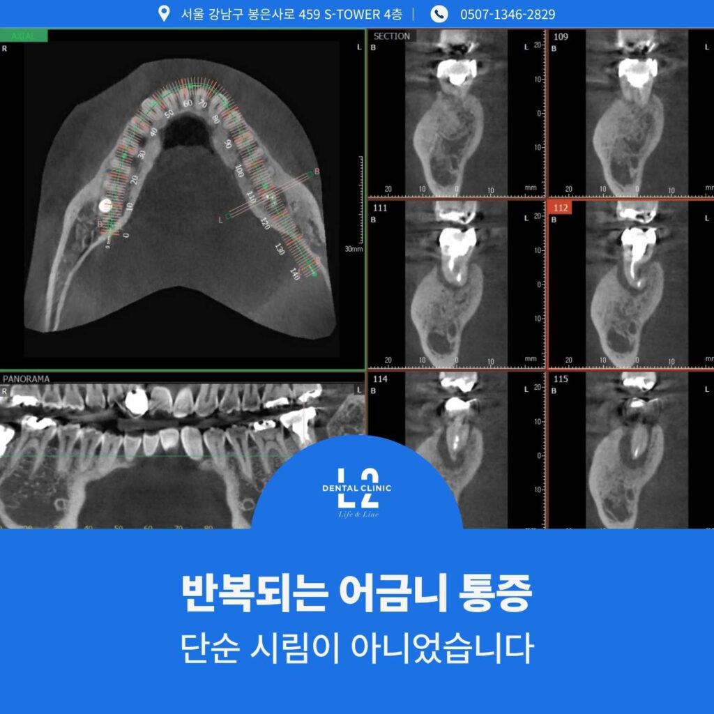 어금니 통증 정밀 진단을 위한 CT 촬영 이미지