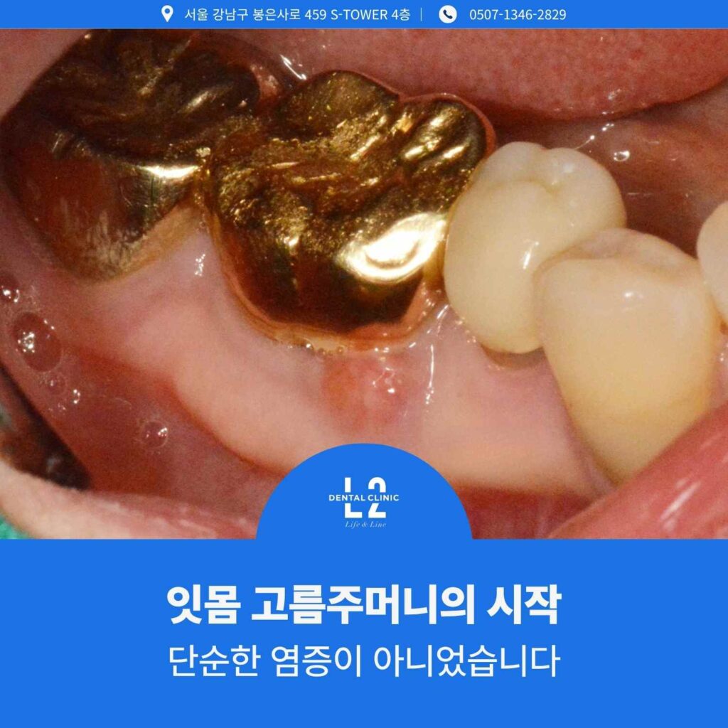 잇몸 고름주머니의 시작과 초기 염증 상태