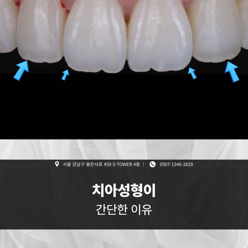 치아 모서리의 굴곡과 형태 변화를 설명하는 화살표 표시된 앞니 사진