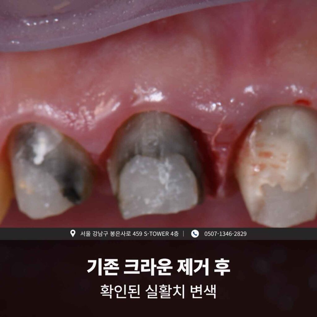 기존 지르코니아 크라운 제거 후 실활치의 변색된 지대치가 드러난 이미지